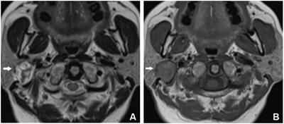 Case report: The diagnostic pitfall of Warthin-like mucoepidermoid carcinoma